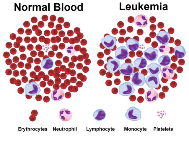 Belajar dari Buah Hati Denada, 5 Upaya Pencegahan Leukimia Ini Nggak Ada Salahnya Dicoba