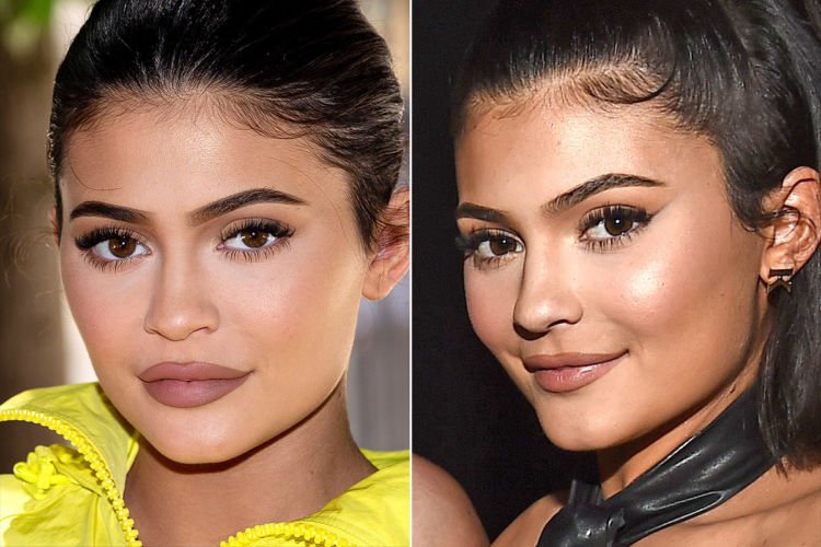 Ratu Kosmetik Hits, Kylie Jenner Resmi Lepas Filler Bibir. Pahami 5 Hal Ini Buat yang Penasaran dengan Prosedurnya