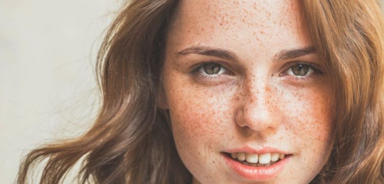 Ini Penyebab Terbentuknya Freckles di Kulit. Beda Sama Tren Make-up, Ada yang Punya Secara Alami