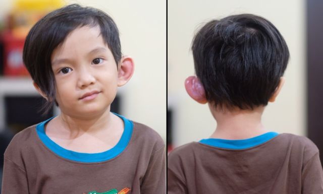 Tentang Infeksi Sinus Preauricular yang Diderita Anak Anji, dan Hubungannya dengan Lubang Telinga Mini