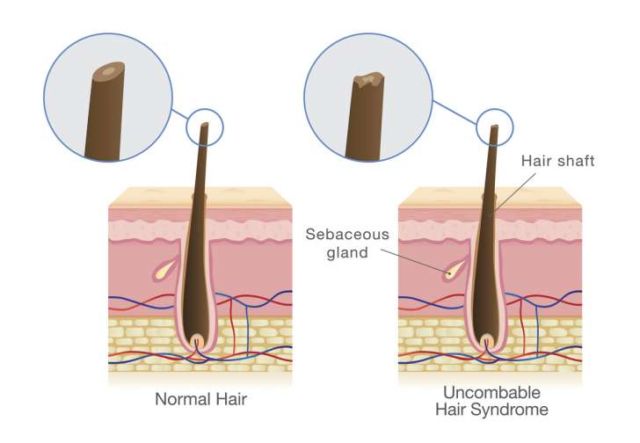 Ini Dia Sindrom Rambut Jabrik, Kondisi Langka yang Bikin Rambut Sulit Sekali Disisir