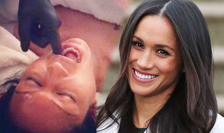 8 Fakta Seputar Facial Buccal, Perawatan 'Obok-obok Mulut' Favoritnya Meghan Markle. Katanya Sih Bikin Glowing Instant