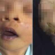 Stop Sembarangan Pegang & Cium Bayi Baru Lahir, Kalau Tidak Mau Kulitnya Jadi Melepuh Kayak Gini