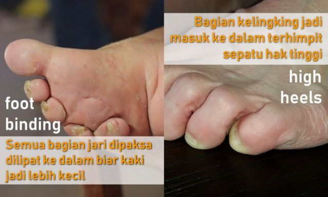 Antara Foot Binding dan High Heels, Perempuan Masih Saja Menyiksa Kakinya Demi Merasa Cantik