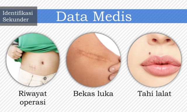 7 Cara Identifikasi Jenazah yang Bisa Diupayakan untuk Kenali Korban. Dari Gigi, DNA, Hingga Tato