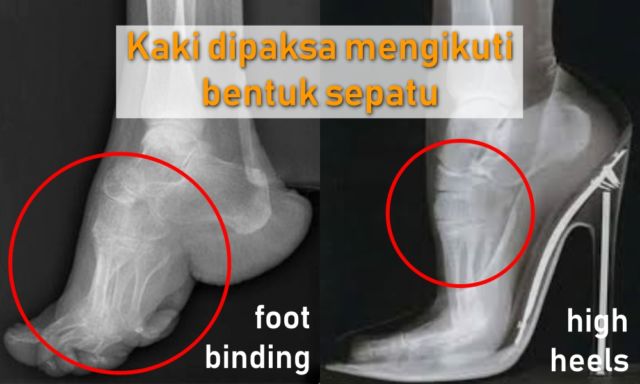 Antara Foot Binding dan High Heels, Perempuan Masih Saja Menyiksa Kakinya Demi Merasa Cantik