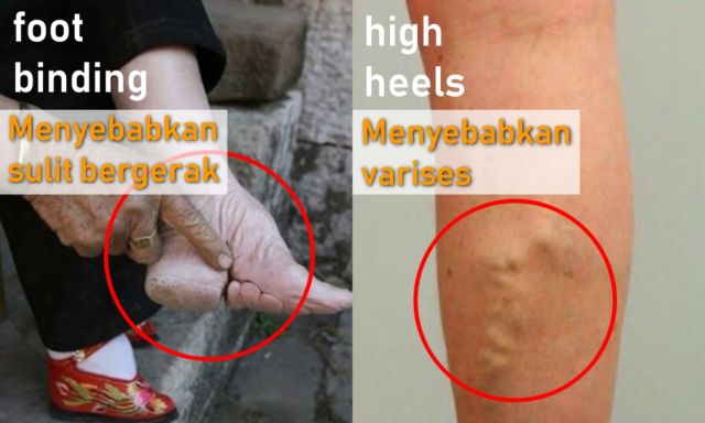 Antara Foot Binding dan High Heels, Perempuan Masih Saja Menyiksa Kakinya Demi Merasa Cantik