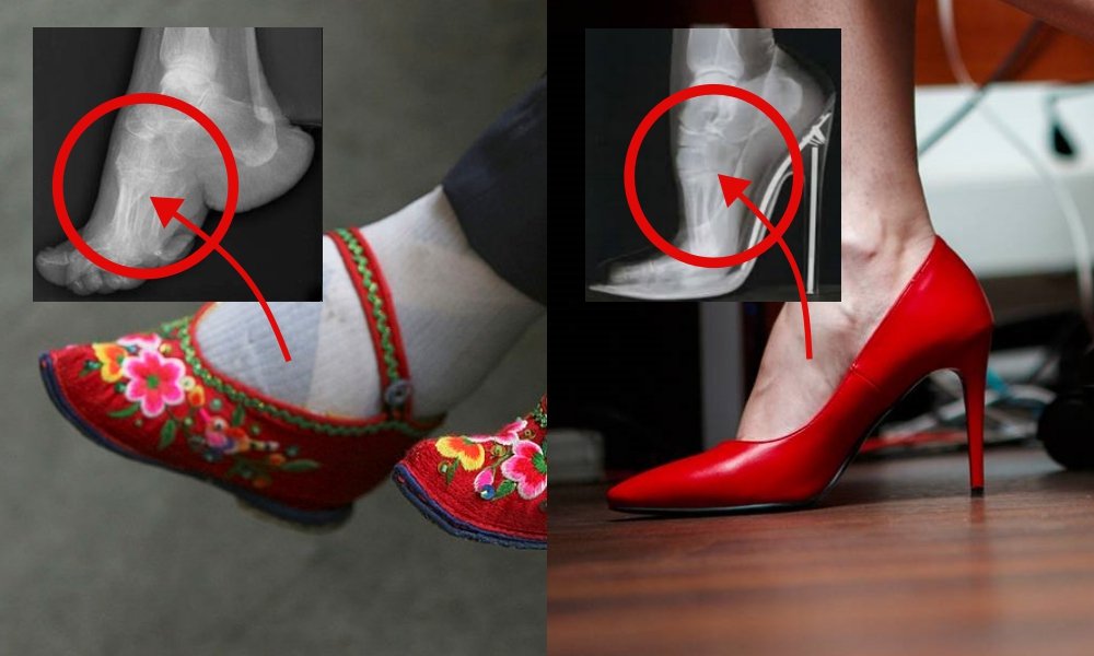 Antara Foot Binding dan High Heels, Perempuan Masih Saja Menyiksa Kakinya Demi Merasa Cantik