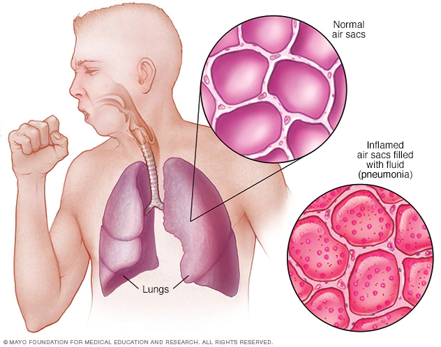 5 Fakta Mengejutkan Tentang Pneumonia, Penyakit yang Diderita Stan Lee Sebelum Meninggal Dunia