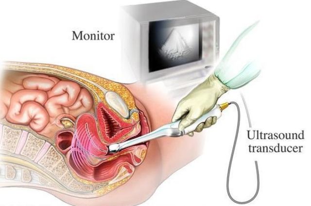 Sama-sama Bisa 'Mengintip' Wajah Janin di Perut, Inilah Bedanya USG 2D, 3D, 4D dan Trans Vaginal