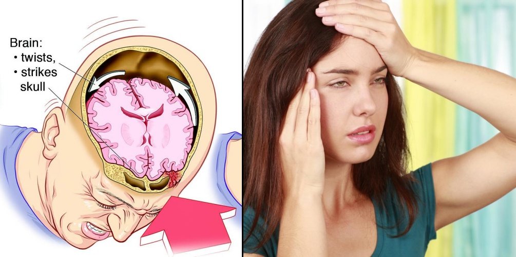 5 Pemicu Penyakit Stroke di Usia Muda. Sering Migrain Salah Satunya