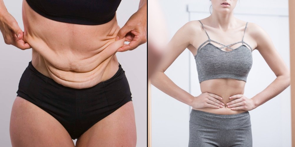 6 Pencegahan biar Kulitmu Nggak Bergelambir Setelah Susut Berat Badan