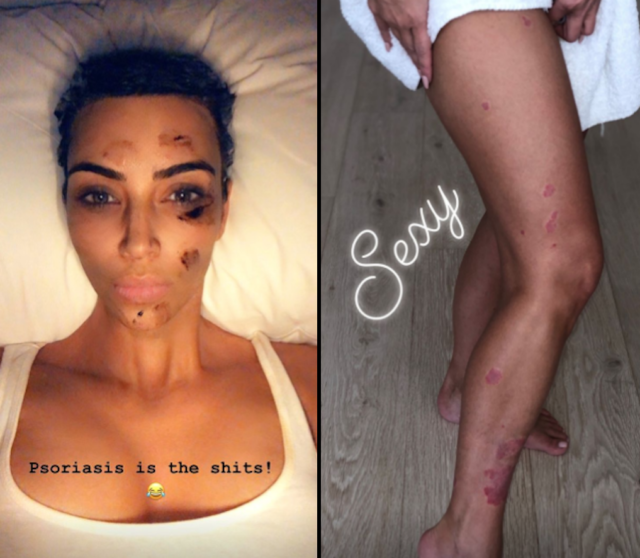 Tentang Psoriasis, Penyakit Kulit yang Diderita Kim Kardashian ini Kabarnya Belum Ada Obatnya