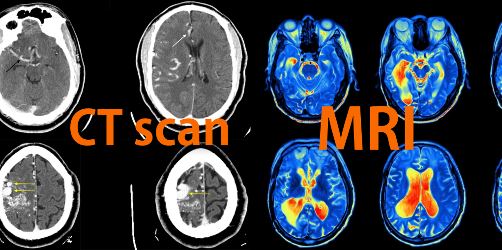 Hasilnya Sama-Sama Mirip Foto Klise hitam Putih, ini Bedanya X-Ray, CT Scan, dan MRI