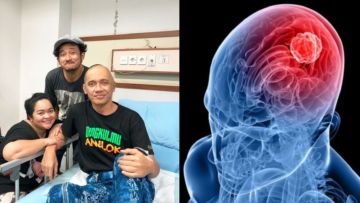 6 Gejala Umum Glioblastoma, Kanker Otak Tergolong Ganas yang Menyerang Agung Hercules