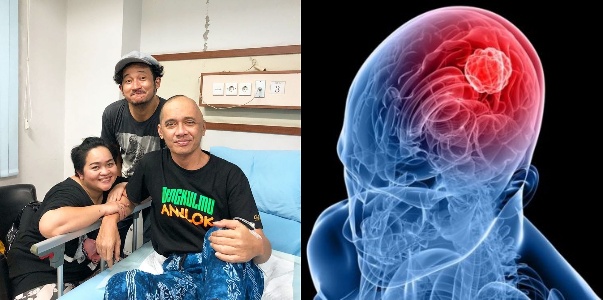 6 Gejala Umum Glioblastoma, Kanker Otak Tergolong Ganas yang Menyerang Agung Hercules