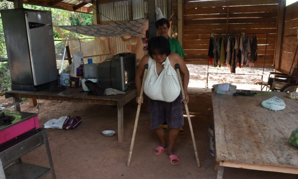 Terkena Kondisi Langka, Payudara Perempuan ini Tumbuh Tak Terkendali. Dokter Cari Tahu Penyebabnya