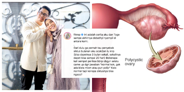 Mengenal PCOS, Sindrom yang Sempat Membuat Fitrop Sulit Hamil Hingga Harus Jalani Terapi