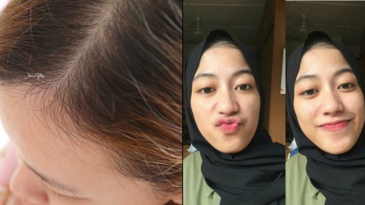 5 Cara Alami Hilangkan Anak Rambut di Dahi yang Suka Berdiri, Biar Tampilan Jadi Lebih Rapi