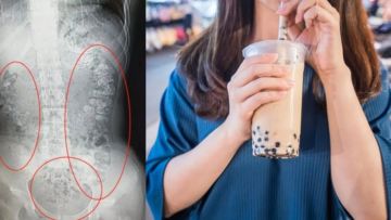 Gadis Tiongkok Sembelit 5 Hari Kebanyakan Bubble Tea. Ini Alasan Bubble Tea Nggak Sehat