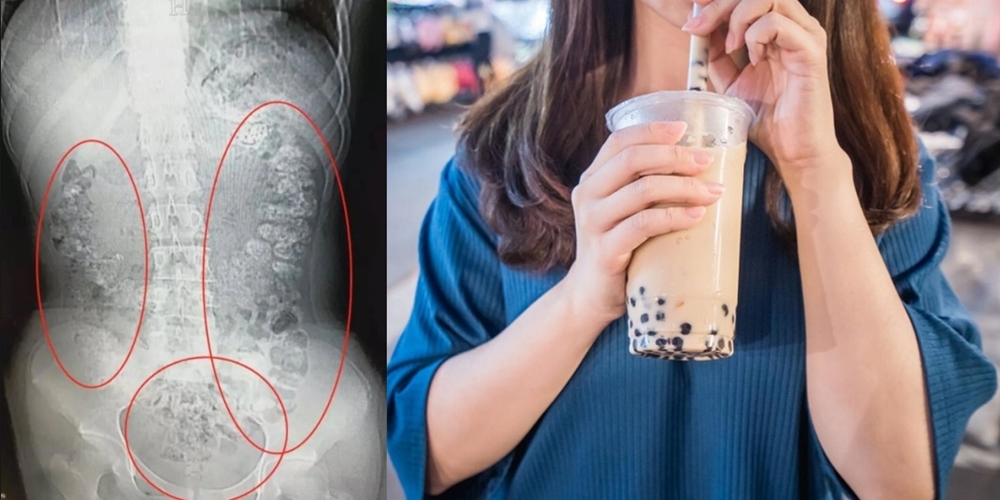 Gadis Tiongkok Sembelit 5 Hari Kebanyakan Bubble Tea. Ini Alasan Bubble Tea Nggak Sehat