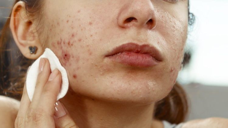 6 Tips Meredakan Wajah Bengkak dan Kemerahan Sehabis Facial. Lumrah kok, Nanti Juga Sembuh