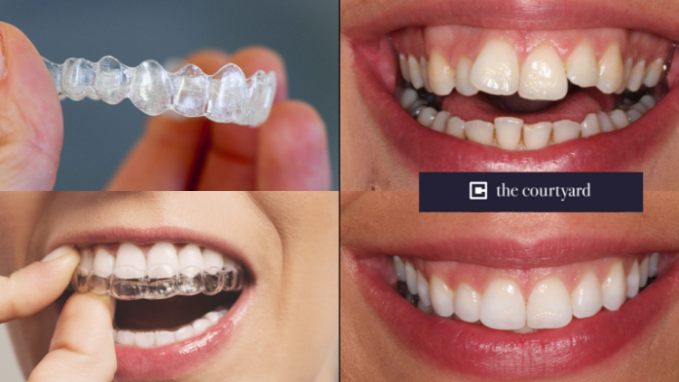 Metode Invisalign: Solusi Canggih Merapikan Gigi Tanpa Behel yang Nyaman dan Fleksibel