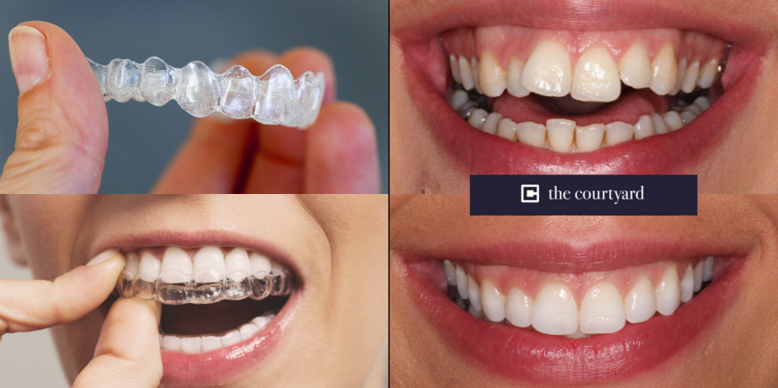 Metode Invisalign: Solusi Canggih Merapikan Gigi Tanpa Behel yang Nyaman dan Fleksibel