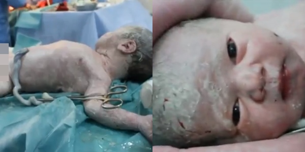 Viral Video Bayi Lahir Meninggal Berhasil Selamat Setelah ‘Ditampar’. Ketahui 9 Pemicu Stillbirth