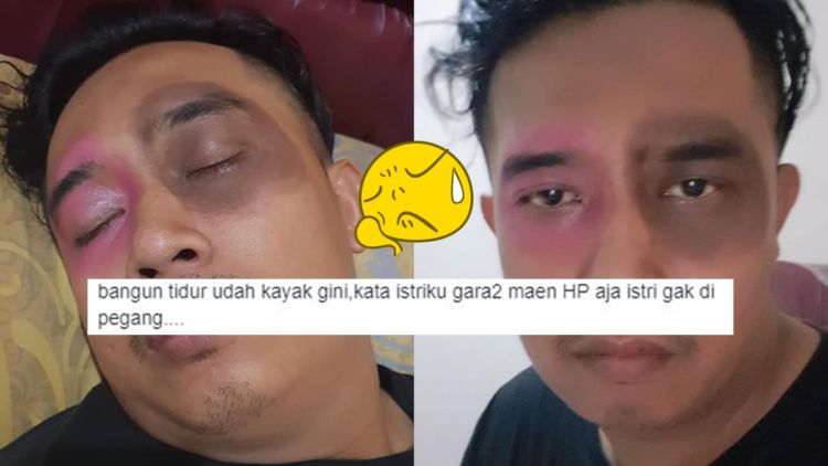 Suami Curhat Matanya Dibikin Hitam oleh Istri Karena Main HP Terus. Bukannya Jera, Malah Bikin Ketawa