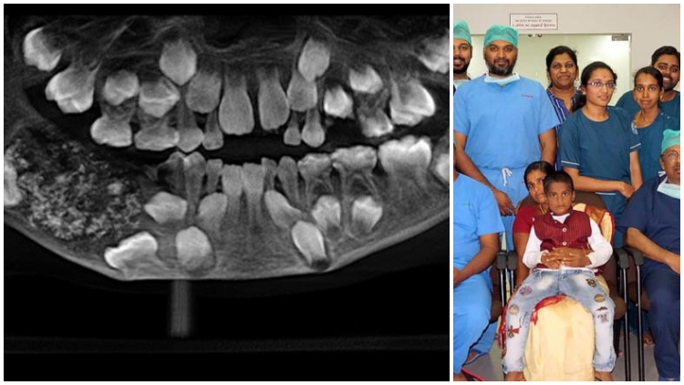 Rahangnya Sakit, Ternyata Dokter Temukan 500 Lebih Gigi Dalam Mulut Bocah di India. Kok Bisa, sih??