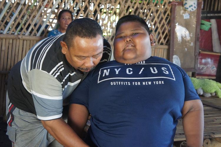 Berbobot 110 Kilogram, Bocah Obesitas Asal Karawang Meninggal Dunia. Begini Kronologinya