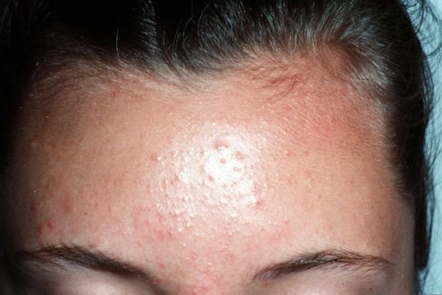 apa itu fungal acne