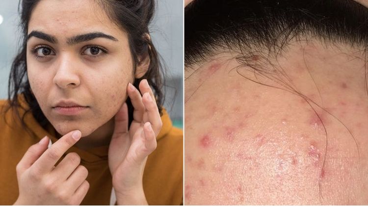 Apa itu Fungal Acne? Pengertian dan Cara Mengatasinya