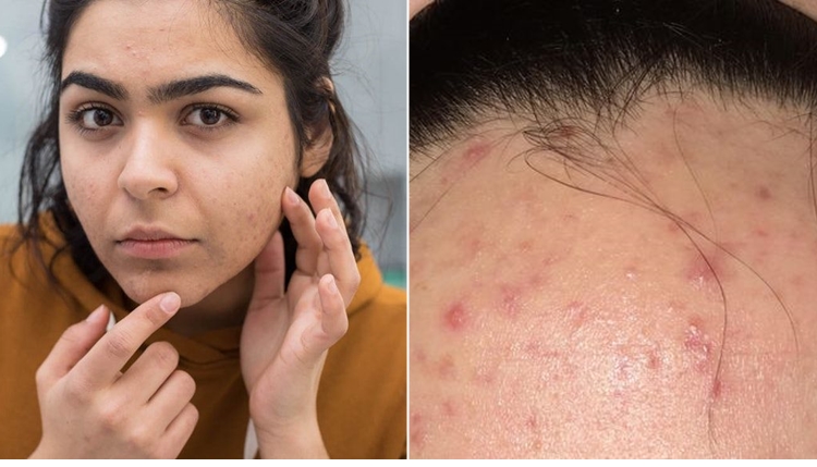 Apa itu Fungal Acne? Pengertian dan Cara Mengatasinya