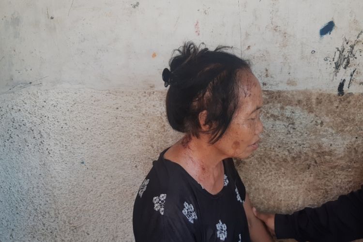 Kisah Pilu Nenek Sakinah: Disiram Cairan Kimia Oleh Orang Tak Dikenal di Perjalanan Pulang