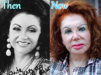 Jackie Stallone Sebelum dan Sesudah Operasi