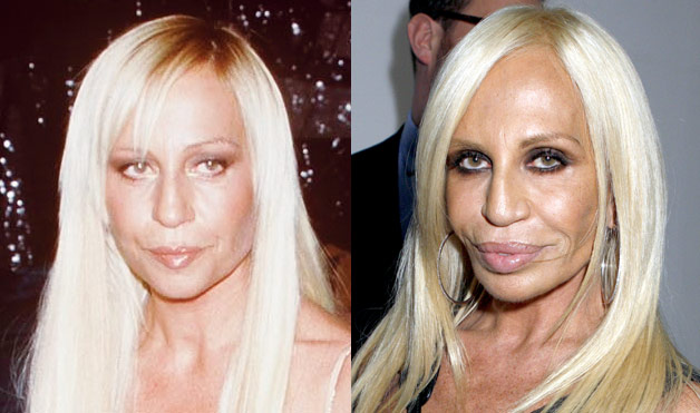 Donatella Versace Sebelum dan Sesudah Operasi