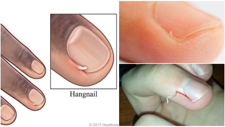 Cara Mengatasi Hangnail, Kulit Lancip yang Sering Nongol di Dekat Kuku Jari Tangan atau Kaki