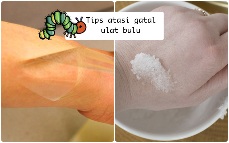 Bukan Digaruk, Ini 6 Cara Atasi Gatal Gara-gara Ketempelan Ulat Bulu. Sebelum Menjalar Lo!