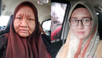 Viral Unggahan Wajah Bumil Bengkak hingga Tak Dikenali. Yuk Ketahui Penyebab dan Cara Mengatasinya!