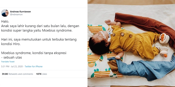 Kisah Hiro; si Kecil Pahlawan Moebius Syndrome, Penyakit Tanpa Ekspresi yang Berdampak Fatal