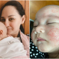 Alami Dermatitis Atopik, Wajah Bayi Mona Ratuliu Dipenuhi Ruam Merah. Sang Ibu Putuskan Diet Sehat