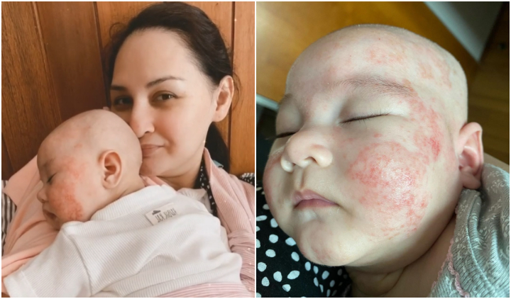 Alami Dermatitis Atopik, Wajah Bayi Mona Ratuliu Dipenuhi Ruam Merah. Sang Ibu Putuskan Diet Sehat