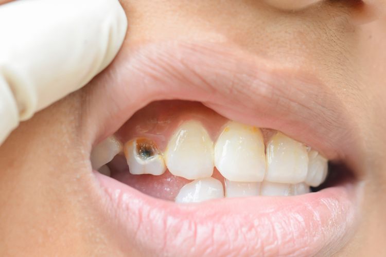 7 Efek Buruk Penggunaan Tusuk Gigi yang Sering Diabaikan. Ya, Wajar Kalau Gigimu Merenggang
