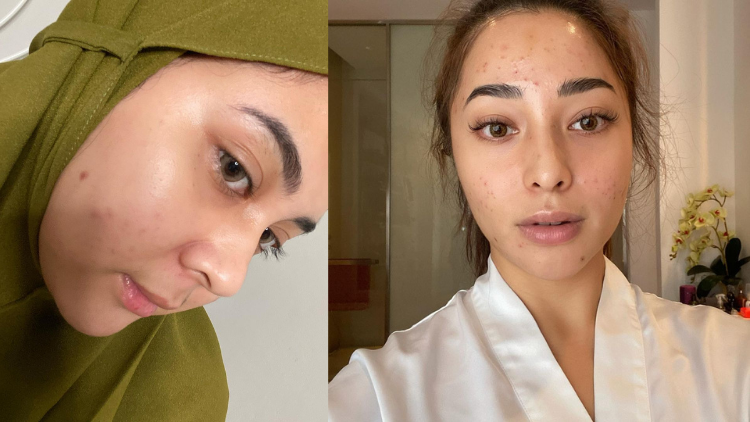 4 Seleb Hits yang Pede Pamer Bare Face dan Cerita Masalah Kulitnya. Jerawatan itu Manusiawi!