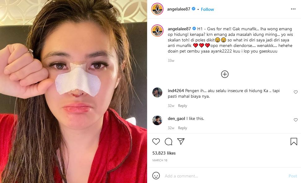 Implan Hidung Bocor, Angela Lee Menyesal Lakukan Operasi. Ingatkan Publik untuk Lebih Hati-Hati