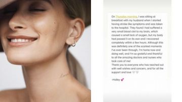 Hailey Bieber Alami Penggumpalan Darah di Otak, Gejalanya Mirip Stroke