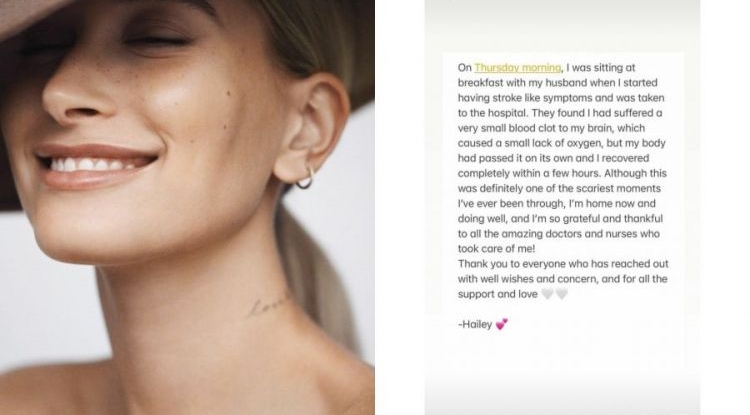 Hailey Bieber Alami Penggumpalan Darah di Otak, Gejalanya Mirip Stroke