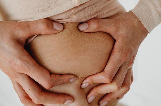 Kenali 7 Penyebab Stretch Mark, Nggak Cuma karena Kehamilan